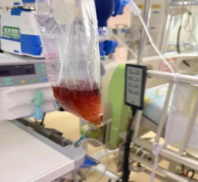 广东5岁男孩吃1包坚果住进ICU！只因含有“它”