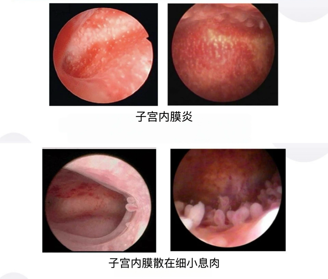 宫内镜怎么进入子宫阴道内镜精准定位活检：小创伤，解决子宫内膜大疑问_https://www.jmylbn.com_新闻资讯_第3张