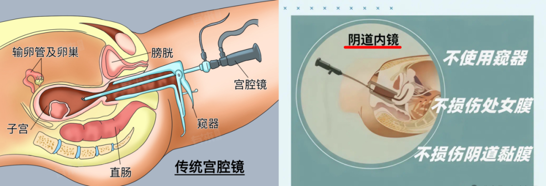 宫内镜怎么进入子宫阴道内镜精准定位活检：小创伤，解决子宫内膜大疑问_https://www.jmylbn.com_新闻资讯_第5张