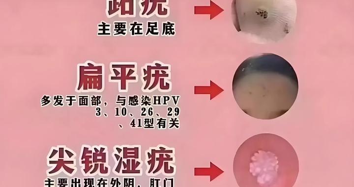刘天骥老中医治疣病经验|寻常疣|扁平疣|薏苡仁|牛蒡子|六神丸_新浪新闻