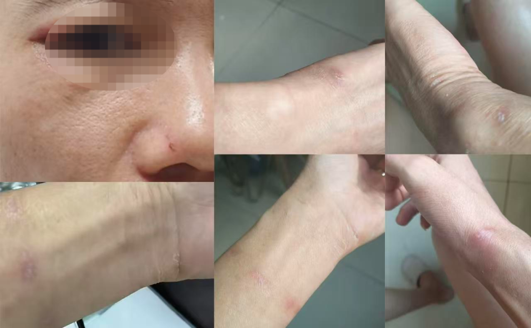 ▲阿東身上的傷痕依舊清晰可見