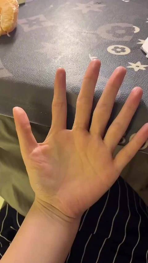 六指,并不太罕见的事情_新浪新闻