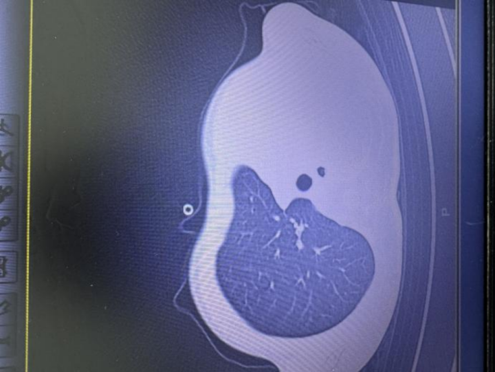 图：影像显示肺白了一半