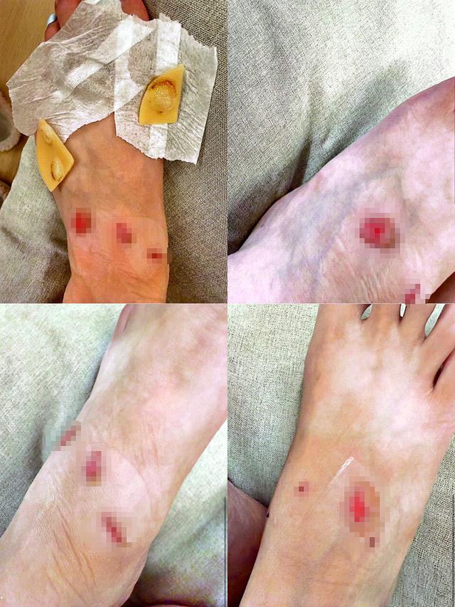 徐女士脚背部磨损图