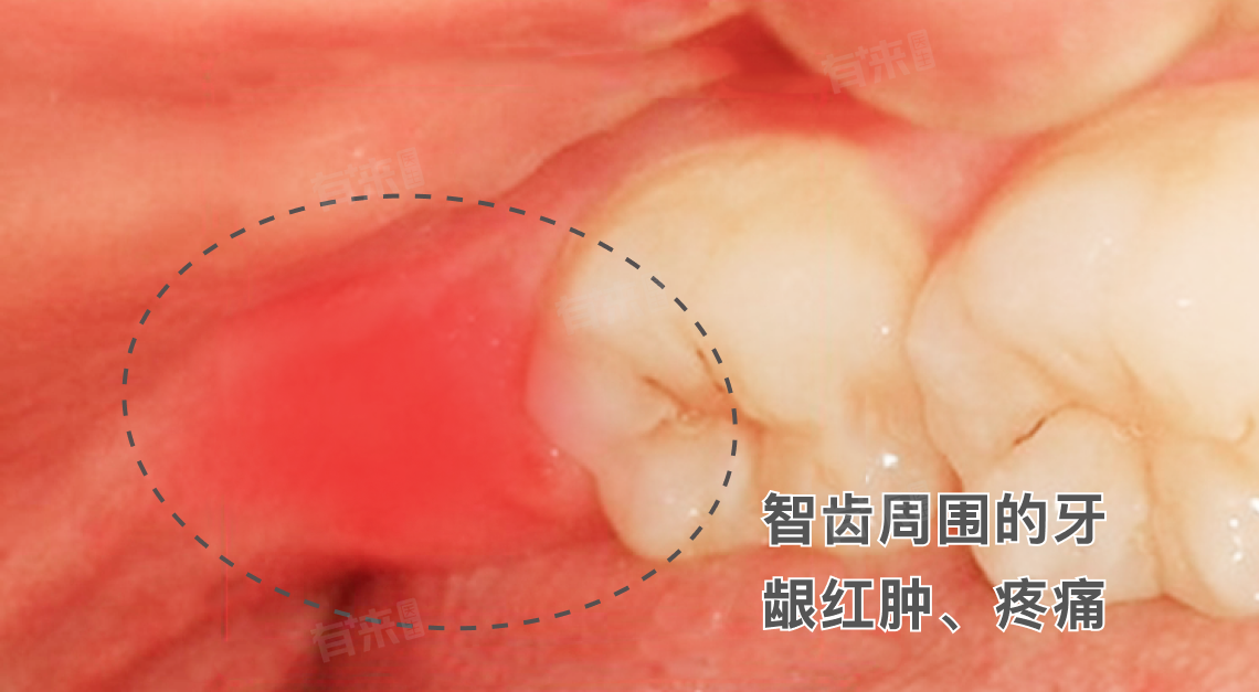 智齿引发的冠周炎是什么症状|口臭|智齿冠周炎|肿胀|煎炸类|口腔_新浪新闻