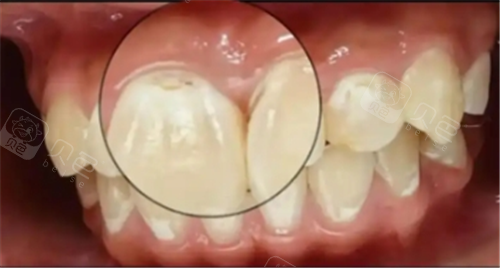 正畸后牙齿脱矿还有救吗?5 种修复方案告别“牙齿小白点”|牙齿正畸|疫情|树脂|釉质|氟化物_新浪新闻