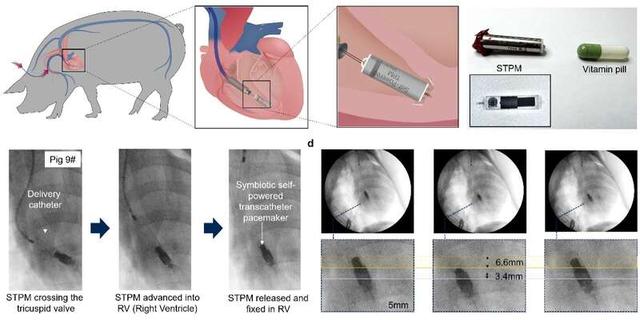 體內(nèi)植入過程示意圖與DR影像。中國科學(xué)院大學(xué)供圖