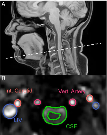 图 | 研究观察了血液和脑脊液流入和流出大脑的情况（来源：上述论文）