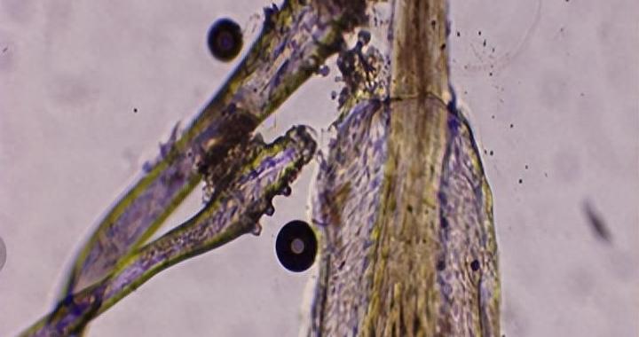 “过年三件套”爆火，第一批受害者出现了！医生提醒：注意螨虫