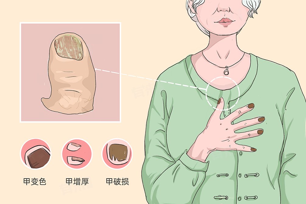 灰指甲症状表现有哪些|感染|甲癣|真菌|变形|变色_新浪新闻