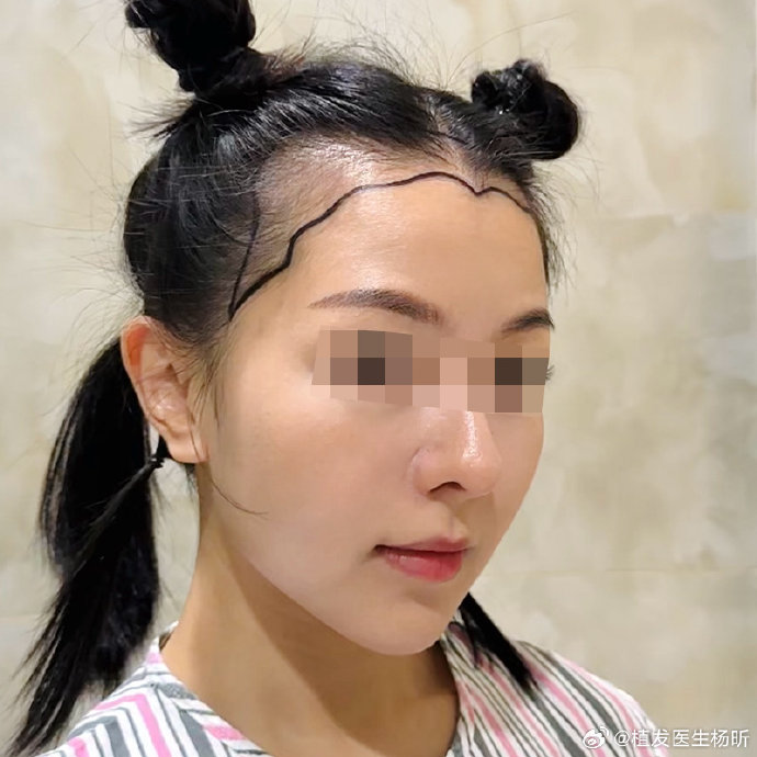 哪些脸型和发际线类型的人最适合或不适合露额头造型?|刘诗诗|面部|下颚线|额角|发型_新浪新闻