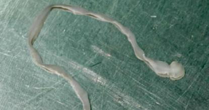 女子脑内捉到一条8厘米的活虫，她曾用生蛙腿塞牙洞