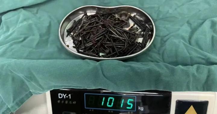 36岁男子胃中取出180颗铁钉，合计重量近1公斤
