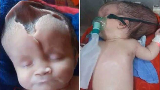 无脑女婴奇迹存活 家人卖房筹钱盼她续命