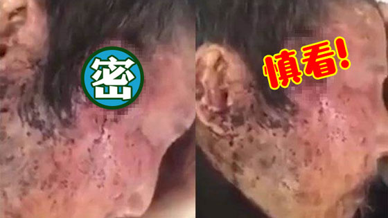 男子头部被啃出大洞 万虫在太阳穴里蠕动