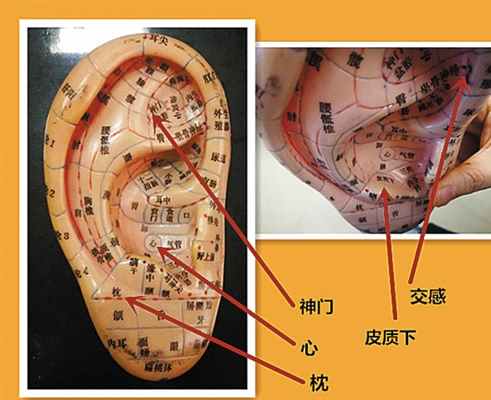 耳穴压豆,拯救你的失眠|耳朵_新浪财经_新浪网
