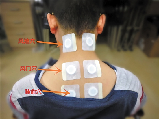 过敏性鼻炎,哮喘…… 试试穴位贴敷