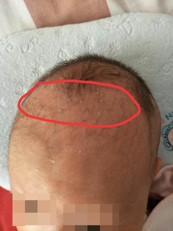 李女士说,"不过几秒钟,宝宝额头上的头发竟掉光了,完全不知道是怎么