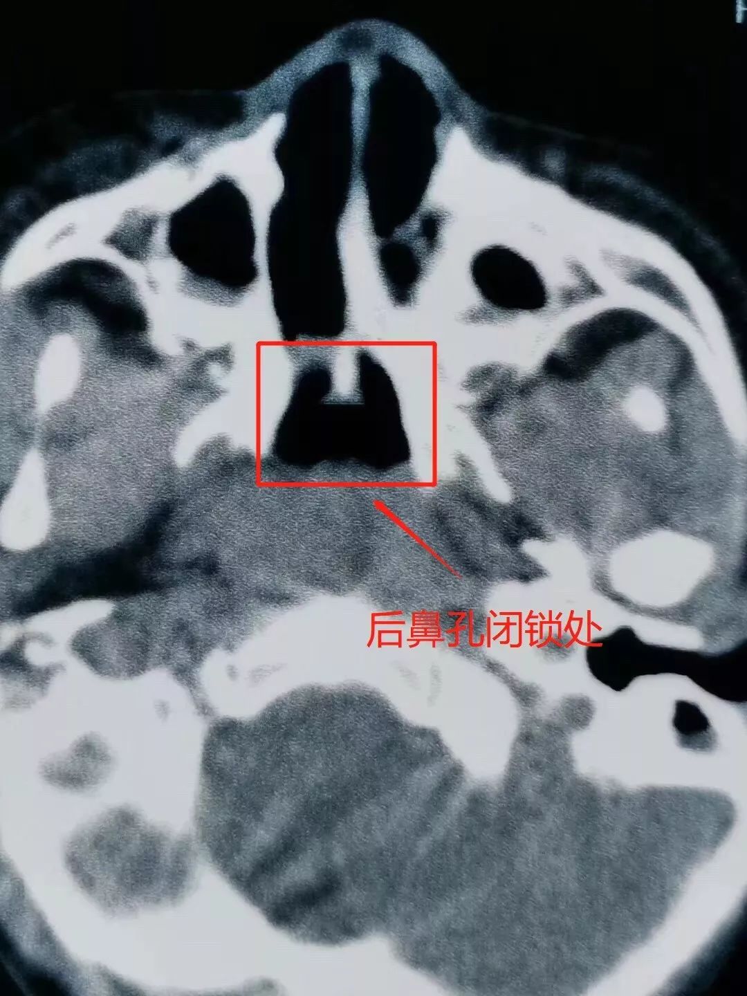 你家小孩有无反复鼻塞打鼾 4岁女孩被查出这种病 有这些症状小心了 手机新浪网