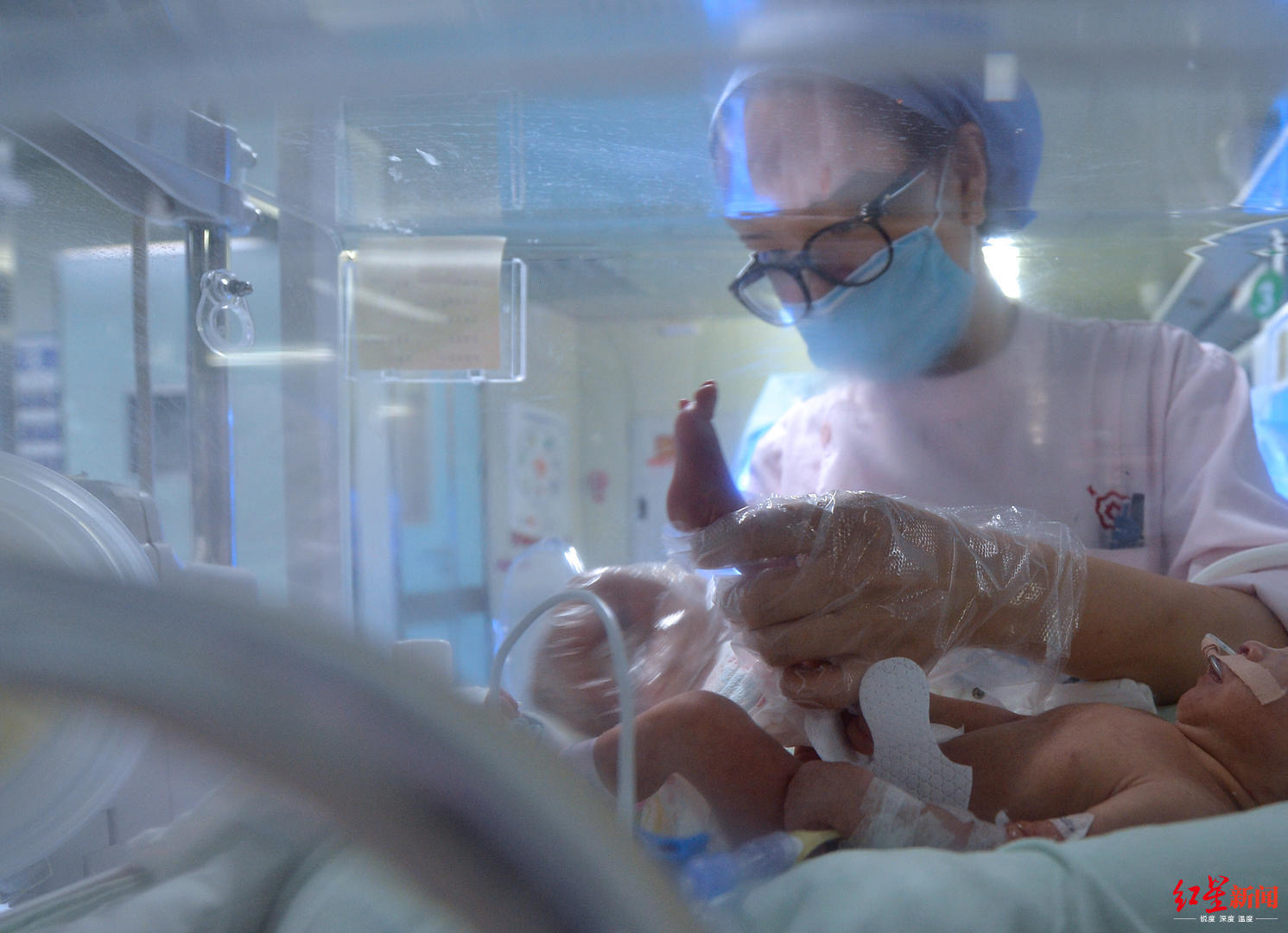 概率低至两亿分之一同卵三胞胎出生就呼吸衰竭