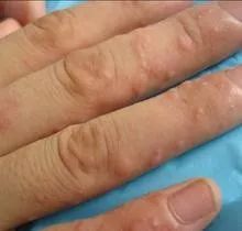 汗疱疹图片:身上出现这种痒痒的小水泡千万别挠 现在看还不晚 图片来源网络