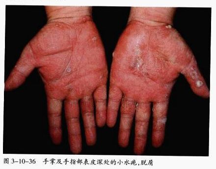 汗疱疹图片:身上出现这种痒痒的小水泡千万别挠 现在看还不晚 图片来源:《中国临床皮肤病学》赵辩