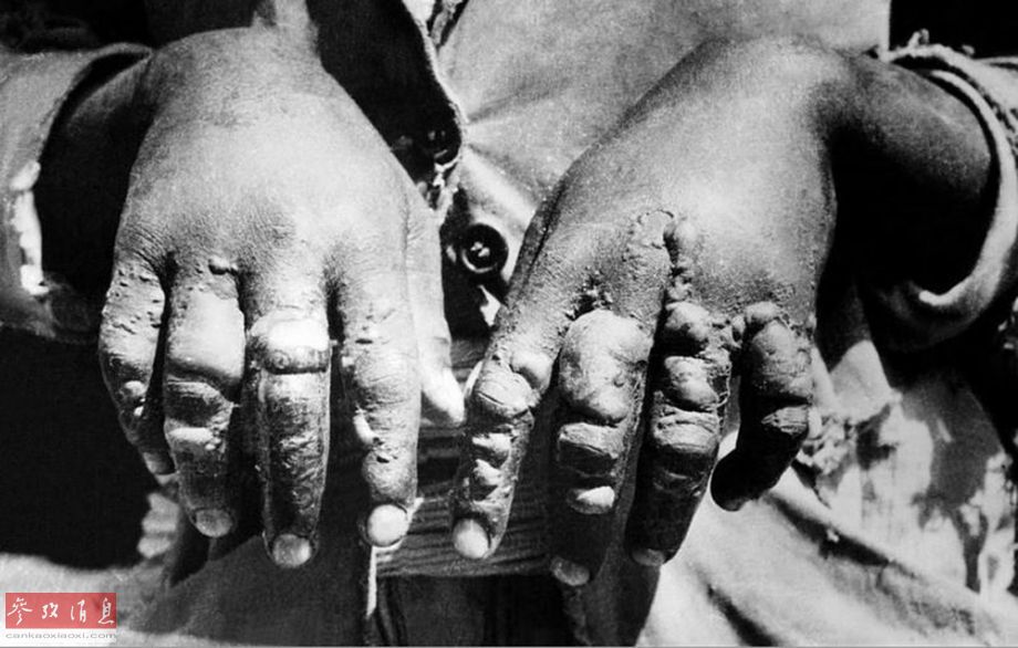 每年殃及3万人!莱姆病被疑源自美军生物战研究|防毒面具|化学武器_新