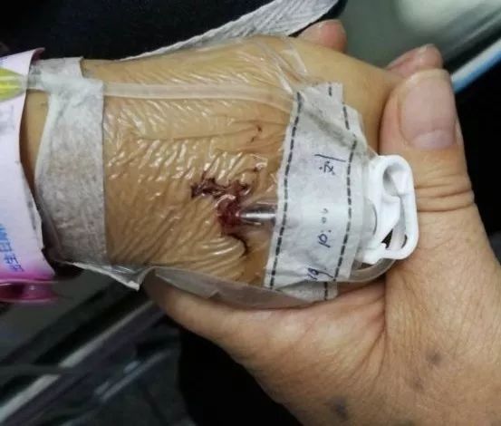 问题1:穿刺点出血对于儿童患者,首选留置针进行静脉输液已是行业共识