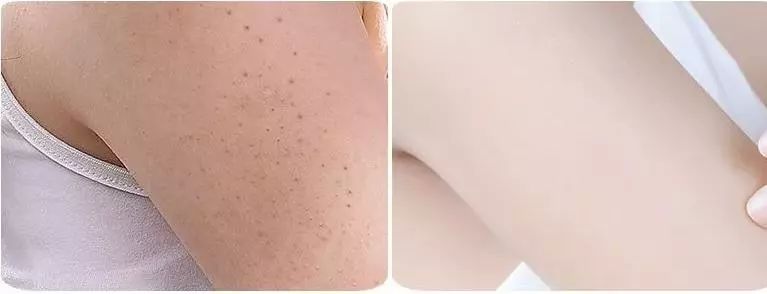 她荐| 暗沉干燥,皮肤一扫光,效果直逼美白针!