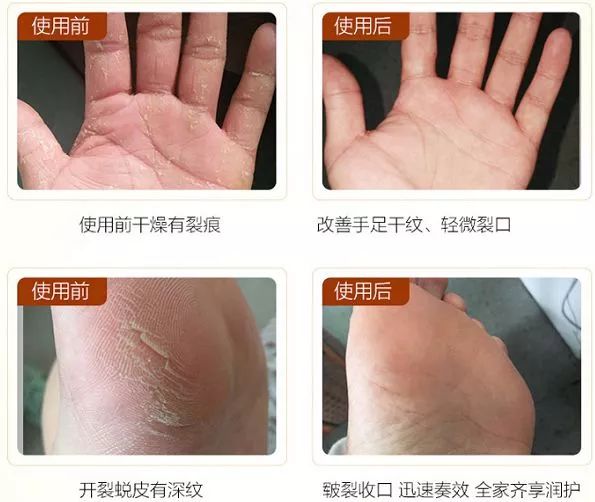 也太厉害了吧!|手足皲裂|肌肤_新浪新闻