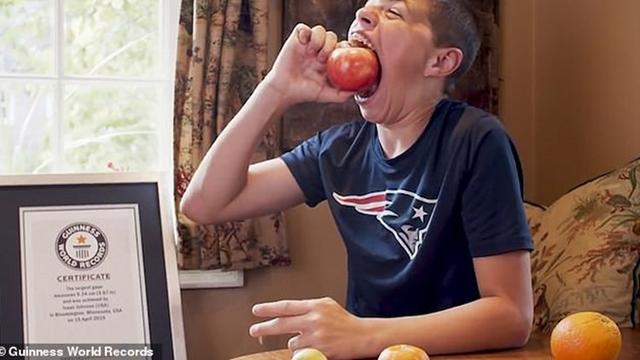14岁男孩嘴巴能张大到近10厘米 轻松吞下苹果创世界纪录