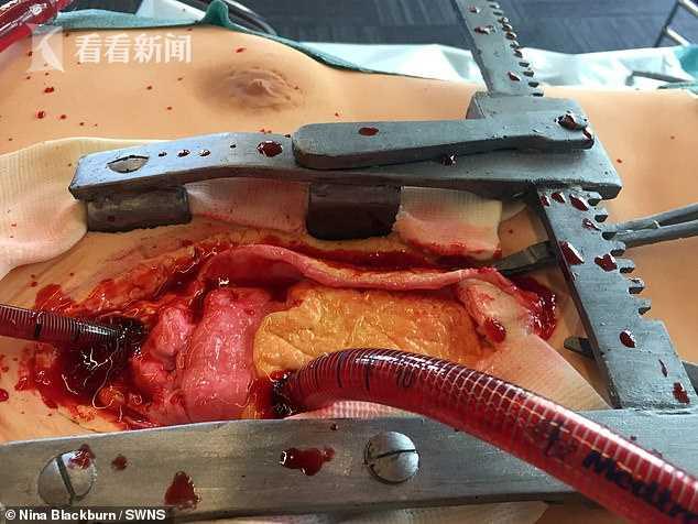 夫妇烘焙仿真开胸手术蛋糕献给医院"血腥味"十足供300人食用