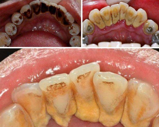 英国变态发明皇室御用360度溶解陈年牙垢比洗牙还干净10086倍