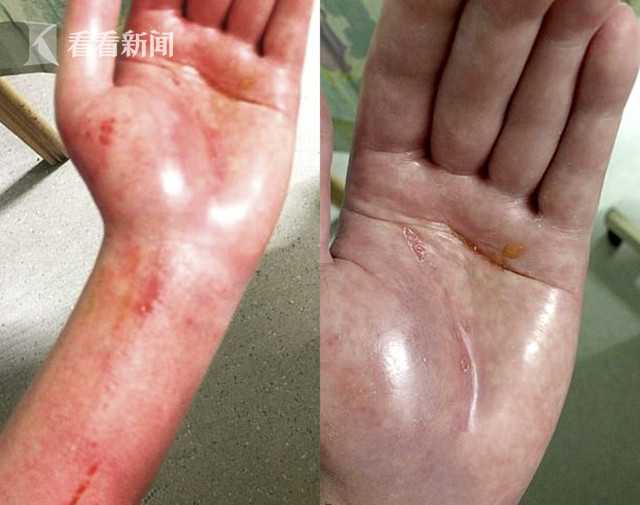 女子误操作触电左手痛似浸滚油被迫截肢五年后逆袭成封面女郎