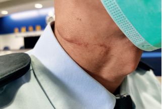 2019年12月5日，被割颈的警员Alex的伤口已经结疤。（本刊记者 陈昊 / 摄）