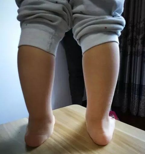 原来,孩子的鞋太软了,孩子又不会表达,原本孩子就有足部问题,现在问题