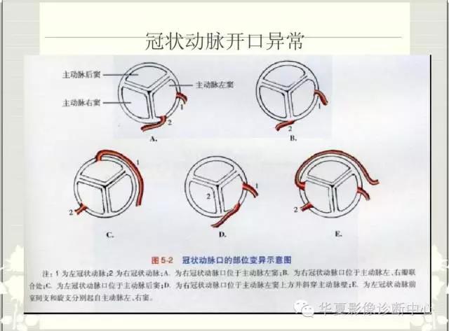 图文详解冠脉解剖及分段
