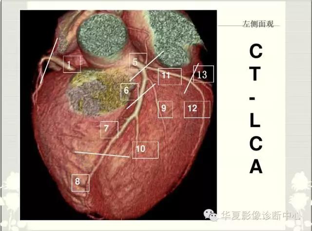 图文详解冠脉解剖及分段