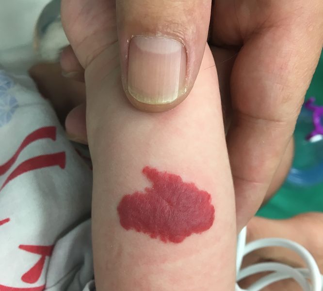 血管瘤|胎记|胡景辉_新浪新闻