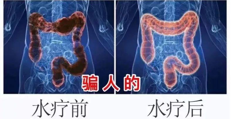 女子在美容院灌肠排毒后肠穿孔这些保养野路子毁了多少人