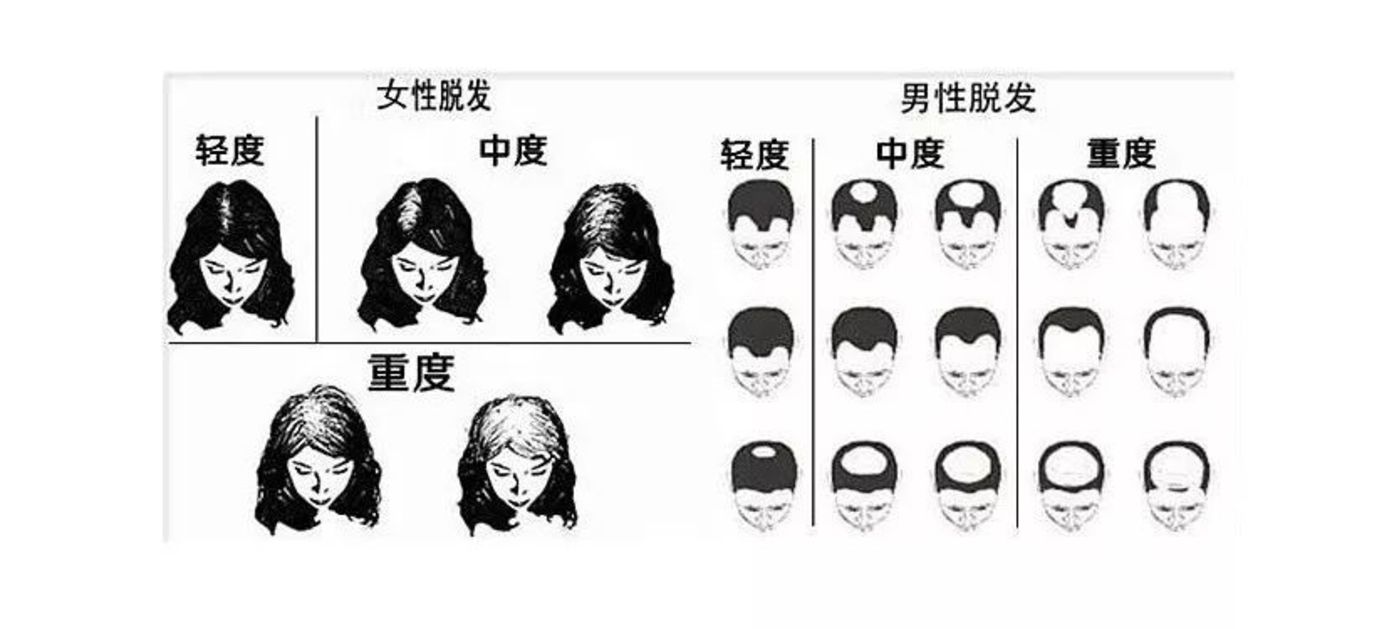 生姜水,黑芝麻和调侃自嘲,都治不了90后的脱发
