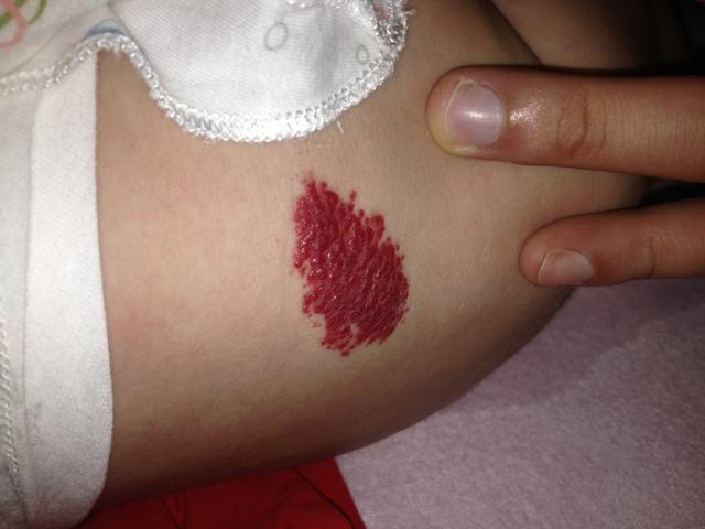 新生儿手臂生出草莓斑宝妈以为碰了医生检查后说要手术