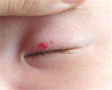 新生儿手臂生出草莓斑宝妈以为碰了医生检查后说要手术