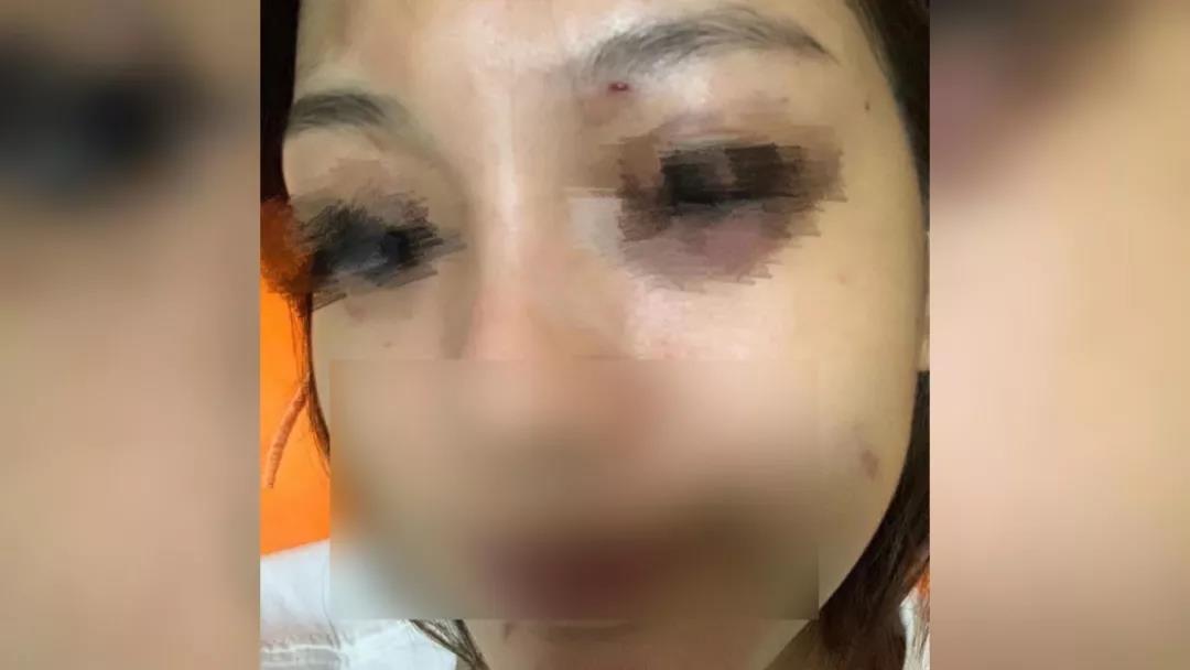 王女士被男友打至雙眼腫脹淤黑