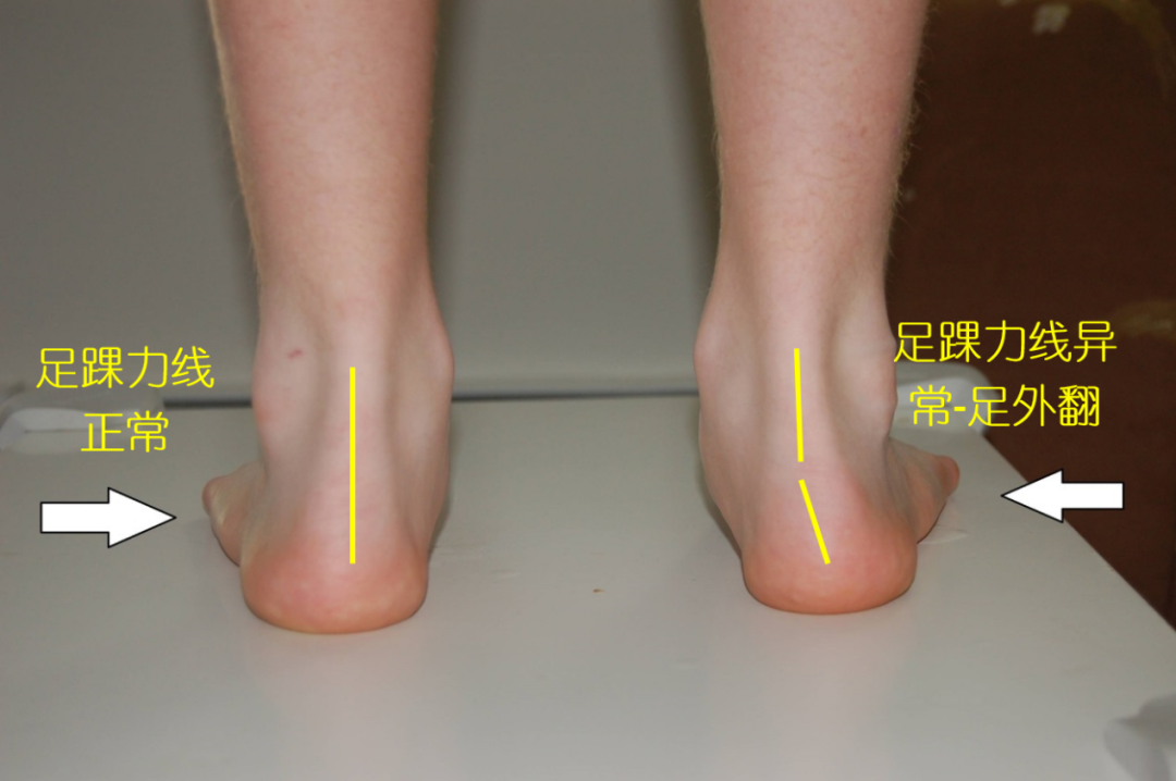 跟腱伤痛何以成为运动人群的死穴?