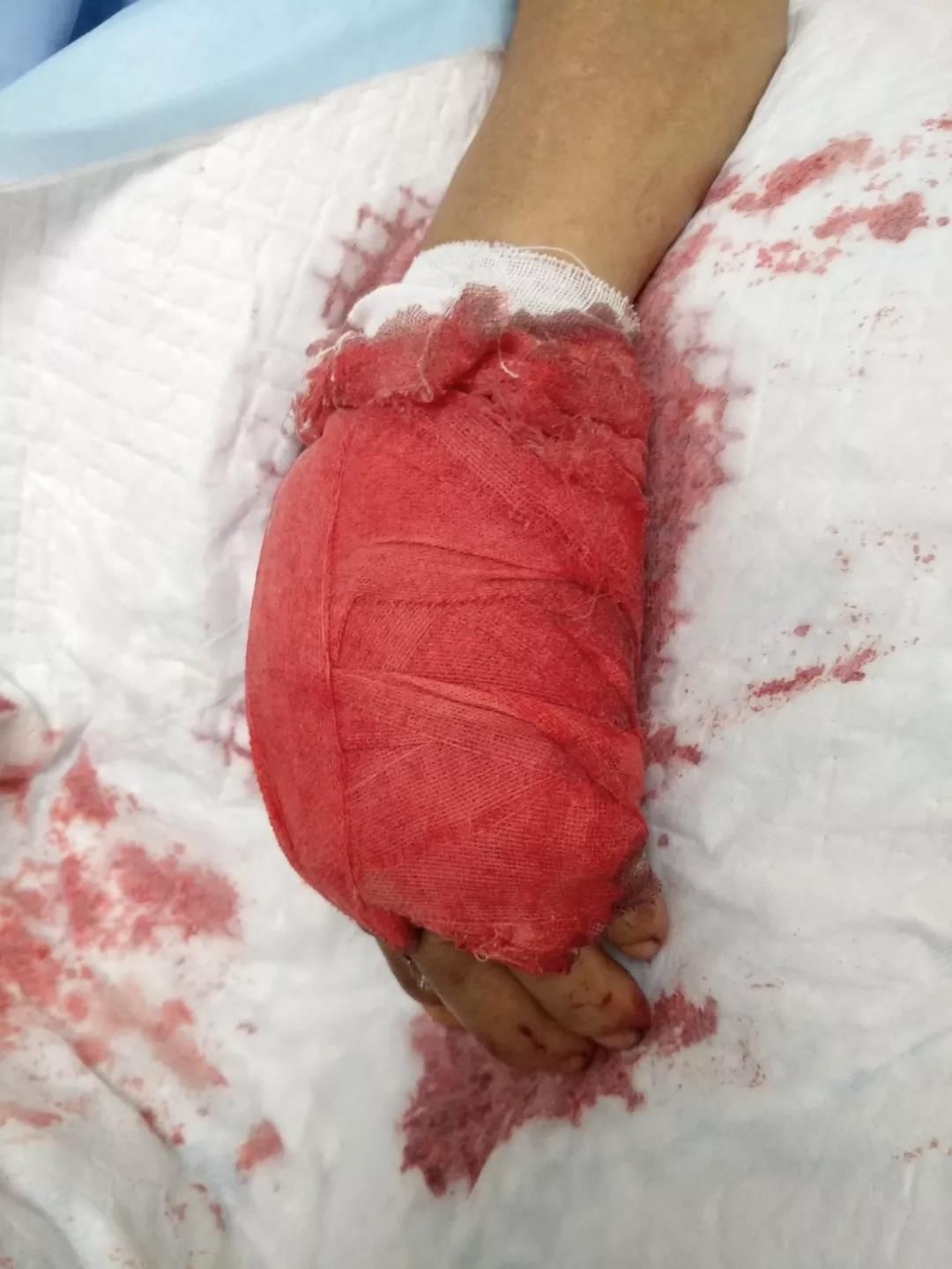 刚开始不痛不肿,之后却失去全身一半血液|血透|失血性休克_新浪新闻