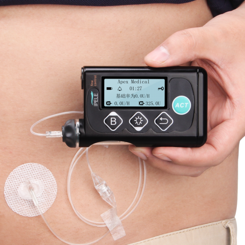 售价28800元首款国产高端胰岛素泵艾派乐正式上市