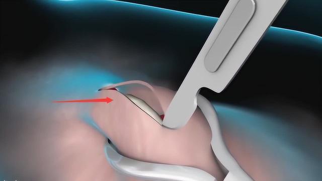 中国男人不愿结扎,根本原因还是心理因素|结扎|结扎手术_新浪新闻