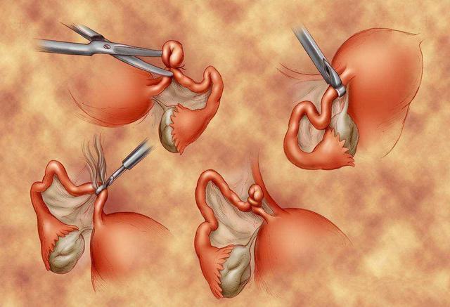 中国男人不愿结扎,根本原因还是心理因素|结扎|结扎手术_新浪新闻