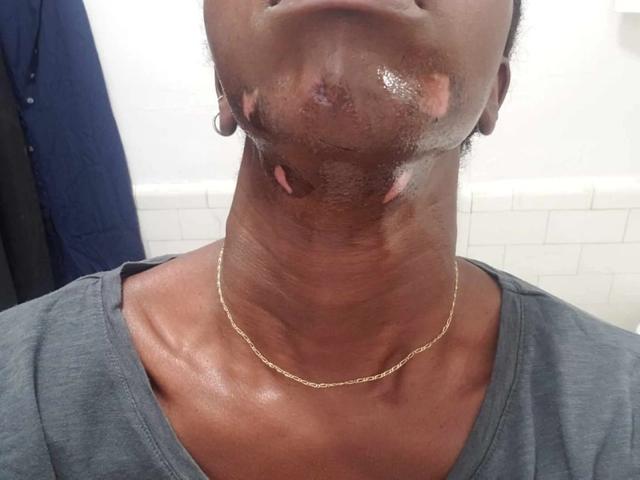 多伦多女子激光脱毛只因一个签名被毁容也投诉无门